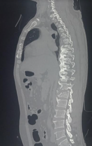 glp 1 ankylosing spondylitis Ankylosing Spondylitis