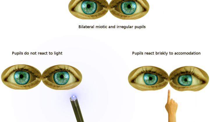 Findings of Argyll Robertson Pupils on Pupillary Reflex Exam. On pupillary exam, Argyll Robertson pupils do not react to light but show prompt constriction with near accommodation.