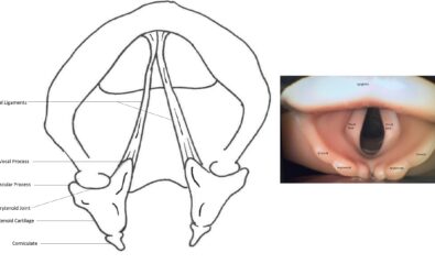 Illustration of laryngeal anatomy (left) and laryngeal anatomy as seen during laryngoscopy.