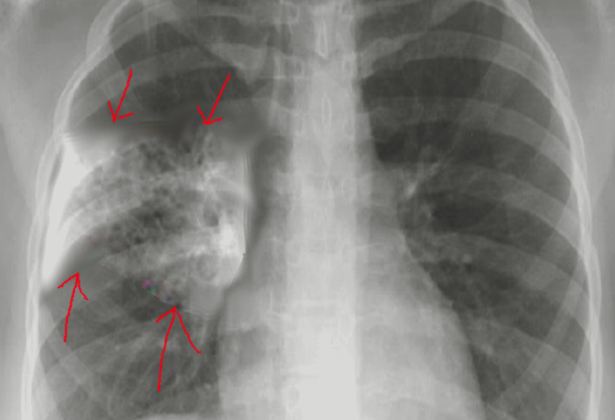 Aspiration Pneumonia. Chest radiograph demonstrating alveolar infiltrates in the superior segments of the right lower lobe in aspiration pneumonia.