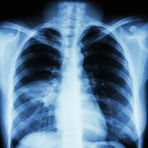 Ventilator-Associated Aspiration Pneumonia. Chest radiograph showing
ventilator-associated aspiration pneumonia.