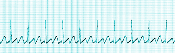 Atrial Flutter, ECG