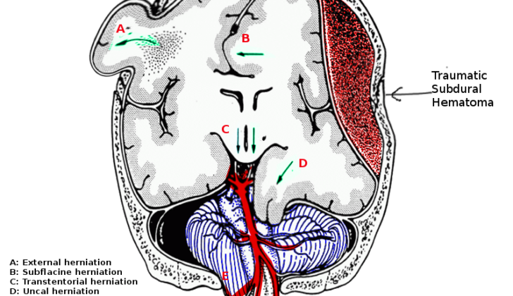Brain herniation