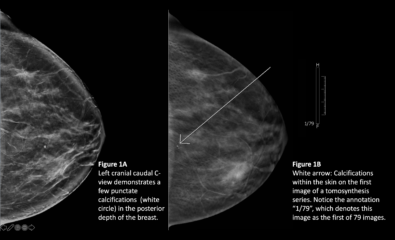 Benign Breast Calcifications - MD Searchlight