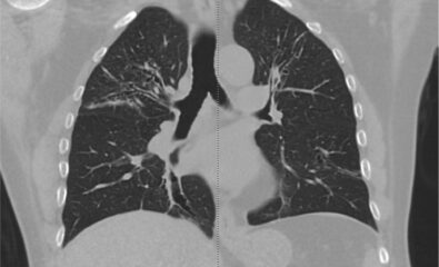 Allergic Bronchopulmonary Aspergillosis on CT Scan. Computed tomography (CT) images reveal bronchiectasis in both upper lobes of a patient with bronchial asthma, indicative of allergic bronchopulmonary aspergillosis.