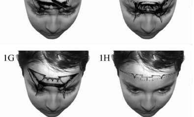 1A. Patient with typical upper lid ptosis and severe brow ptosis. Incisions for midforehead lift may be staggered as shown here to prevent a long horizontal scar. 1B. Sensory and motor nerve supply of the face. 1C. Transverse forehead incisions may be staggered or be broken up as shown to improve the final scar. 1D. Dissection performed in the subcutaeneous plane. 1E. Transverse incisions are made in the galea to access the corrugator and procerus muscles. These incisions are kept in the middle to prevent injury to the supraorbital nerve branches. 1F. Once exposed, the corrugator and procerus muscles are attenuated. 1G. The galea is shortened as desired and sutures placed. 1H. Elevation of the cutaneous structures is obtained and relevant trimming performed. 1I. Meticulous subcuticular closure is performed with no tension on the skin edges. 1J. A 68-year-old man with markedly overactive corrugator and procerus muscles. 1K. A reasonable elevation of his brows has been achieved.