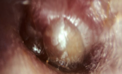 Example of bullous myringitis.