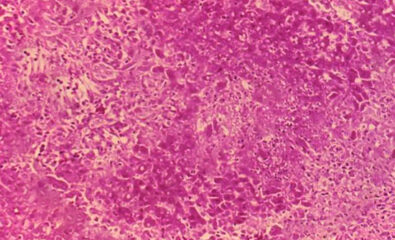 Histology showing caseating granuloma caused by brucellosis infection.