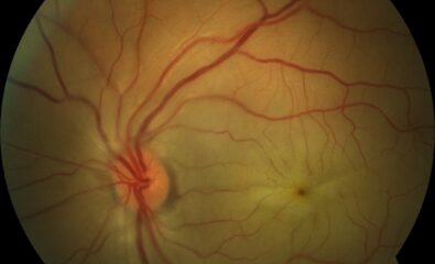 Central Retinal Arterial Occlusion. The retina appears whitened, and the blood column is segmented (boxcarring) around the fovea.