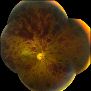 Central Retinal Vein Occlusion