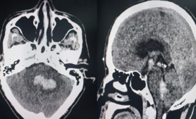 Cerebellar hematoma