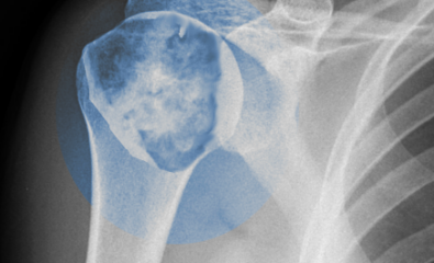 Chondrosarcoma