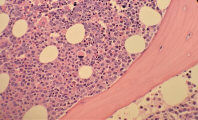 Chronic Myeloid Leukemia. Micrograph of a bone marrow biopsy of chronic myeloid leukemia showing hypercellularity and expansion of immature granulocytic paratrabecular cuff.