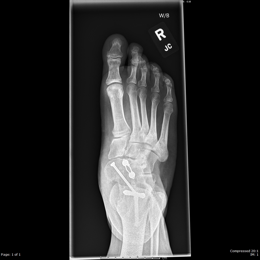 Clubfoot - MD Searchlight