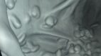 Colonic polyps
