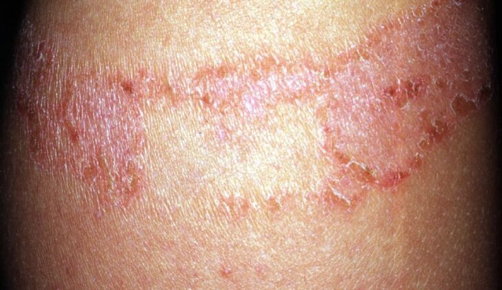 Contact Allergy From Band-Aid