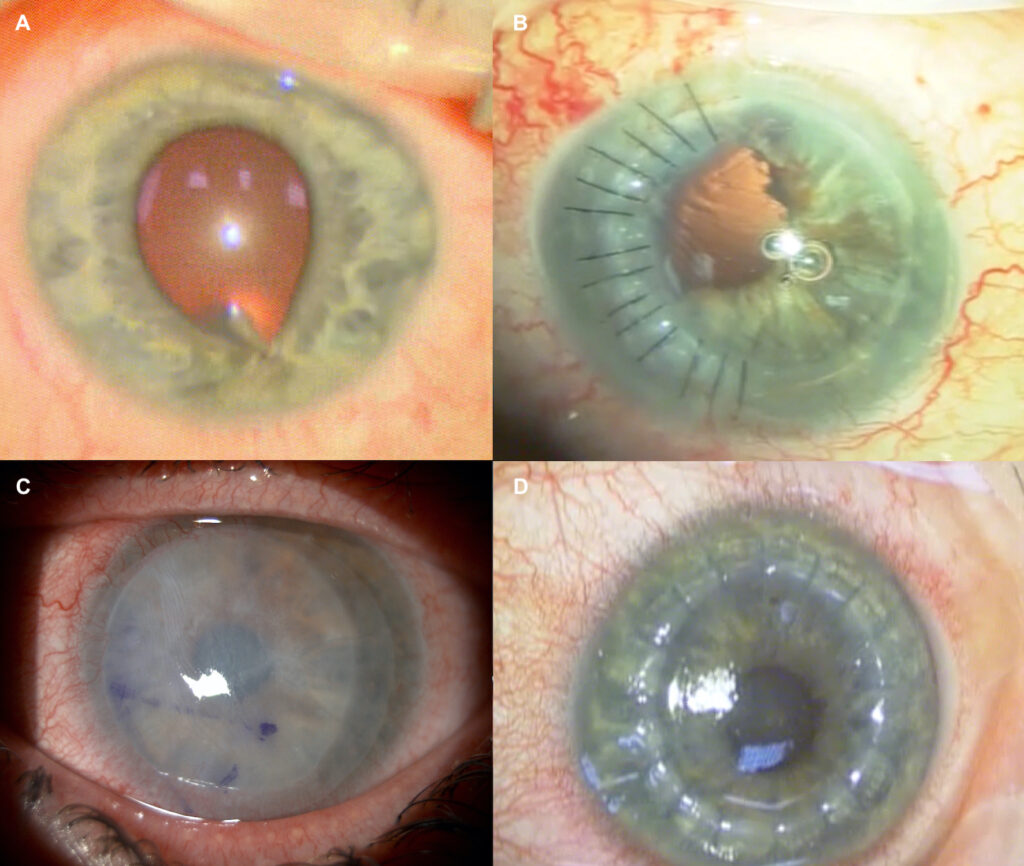 Corneal Rust Ring Complications
