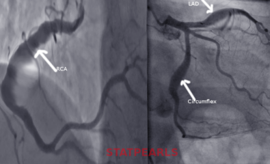Coronary Artery Ectasia. The image reveals CAE, a dilation of the coronary artery lumen.