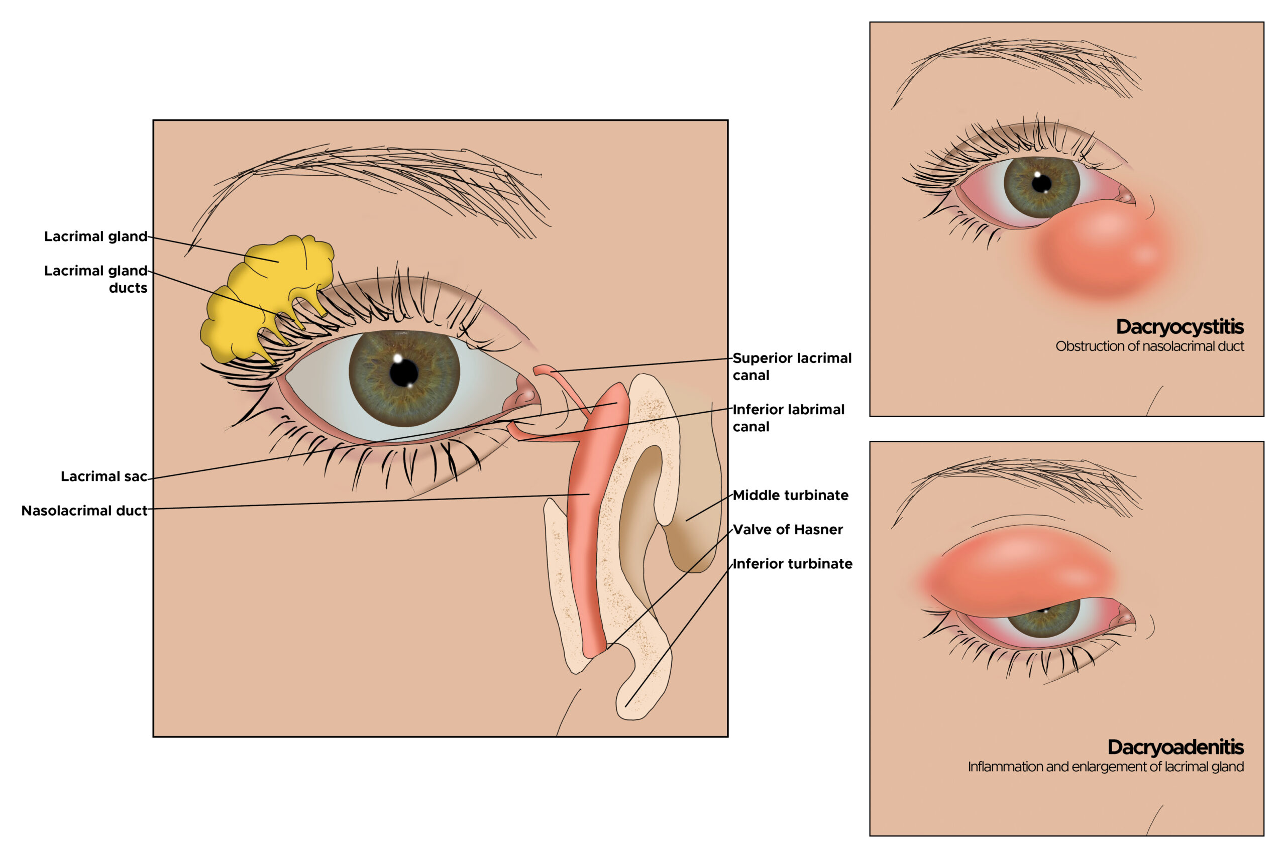 Dacryoadenitis - MD Searchlight