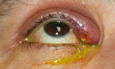 Upper canaliculitis with swelling of the medial upper eyelid, mucoid discharge from the upper punctum and a history of previous placement of a Herrick intra-canalicular plug. The intracanalicular plug was removed via an open dacryocystorhinostomy and the debris within the canaliculus was removed.