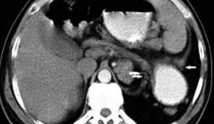 delayed diaphragmatic hernia on CT imaging