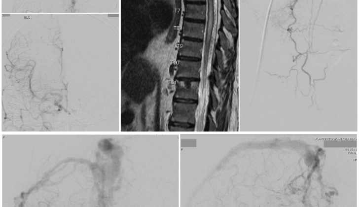 Arteriovenous Fistula.  A Cognard type 3 dural arteriovenous fistula (top left 2 images) is seen on cerebral catheter angiography with arterial phase right common carotid injections, lateral view (top) and anteroposterior view (bottom). Bottom 2 Images - A cerebral catheter angiogram with anteroposterior (left) and lateral (right) views, late arterial phase, shows a Cognard type 4 dural arteriovenous fistula with multiple feeding arteries, cerebral and cerebellar draining veins, and venous ectasia of the superior sagittal sinus. A thoracic MRI (Left top 2 images) was obtained in a 60-year-old man presenting with symptoms of thoracic myelopathy, which showed cord signal change extending from the T5 level to the conus as well as a serpiginous appearing flow void posterior to the spinal cord concerning for a spinal dural arteriovenous fistula. A catheter angiogram was then performed (right).