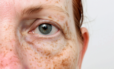 Reticular Hyperpigmentation on the skin