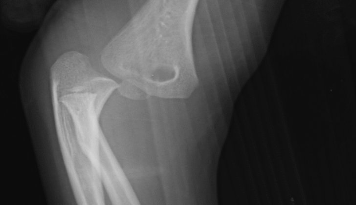 Elbow Fracture on Lateral Radiograph. Posterior dislocation is visualized.