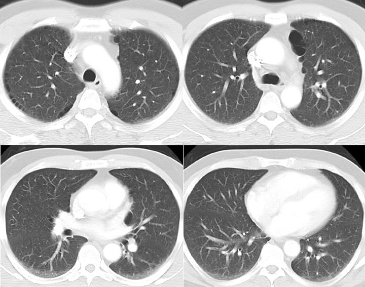 CT Scan COPD, Paraseptal Emphysema