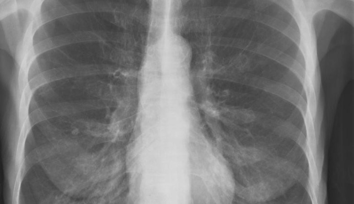X-ray, COPD, Chronic Obstructive Pulmonary Disease, Emphysema