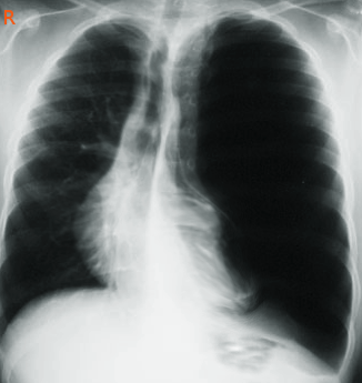 Congenital Lobar Emphysema. A chest radiograph in a patient reveals
characteristic findings of congenital lobar emphysema, including a distended,
hyperlucent affected lobe with a fine vascular network. This distension pushes
the mediastinum and compresses the ipsilateral lobe.