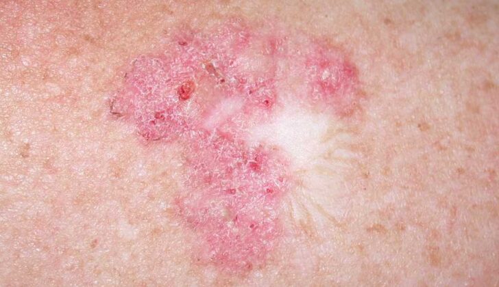 Superficial Basal Cell Carcinoma. Superficial BCCs present as a pink-red, scaly, macule or patch, which may contain telangiectasia. They have a predilection for the shoulders, chest, or back, and multiple lesions may be present.