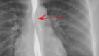 Perforation of the esophagus