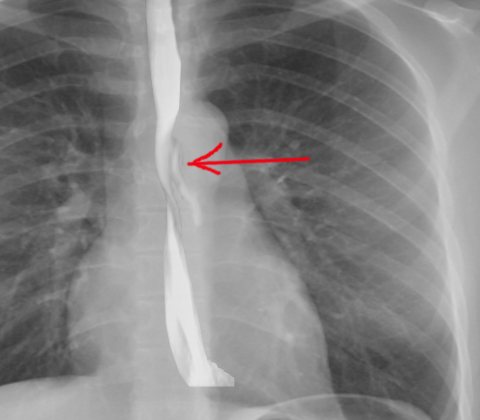 Perforation of the esophagus