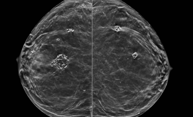 Benign breast calcification: Dystrophic calcifications from fat necrosis are seen within both breasts.