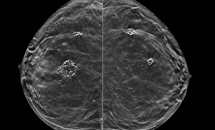 Benign breast calcification: Dystrophic calcifications from fat necrosis are seen within both breasts.