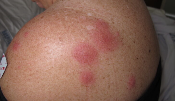 Neutrophic Dermatosis