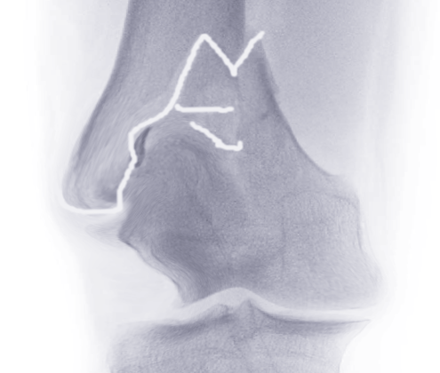 Distal femur fracture