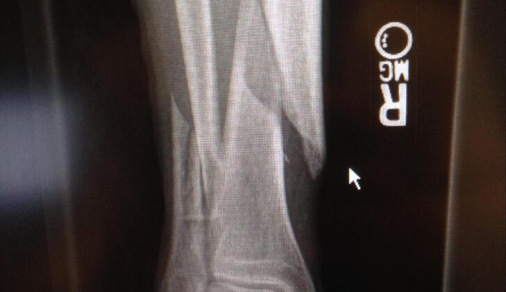 Tibial Fracture Spiral fracture of the distal one-third tibia and fibula.