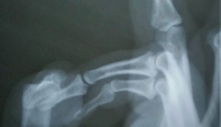 Distal Interphalangeal Joint Dorsal Dislocation