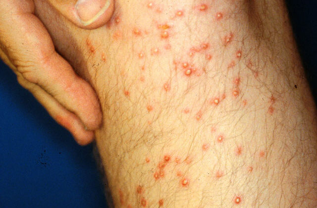 Sterile pustules following a fire ant sting.