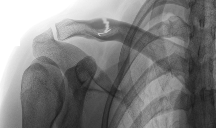 Clavicle fracture
