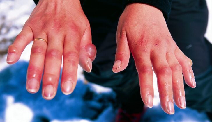 Frostbite to fingers/hands