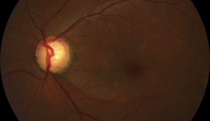 Glaucomatous Optic Nerve Head Showing Inferotemporal Retinal Nerve Fiber Layer Defect. Increased intraocular pressure can result in reduced blood supply to the optic nerve fibers, resulting in subtle ischemic injury.