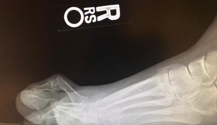 Hammertoe Lateral weight-bearing radiograph demonstrating a hammertoe deformity with extension at the MPJ and contracture at the PIPJ