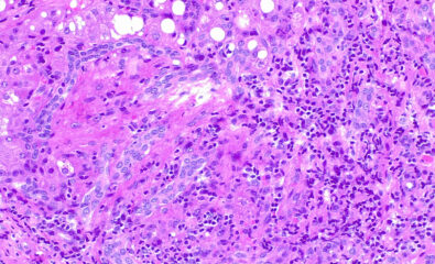 Liver Biopsy Hematoxylin and Eosin Stain. Liver Biopsy hematoxylin and eosin stain showing chronic inflammation in a distorted portal space, a feature of chronic hepatitis.  
