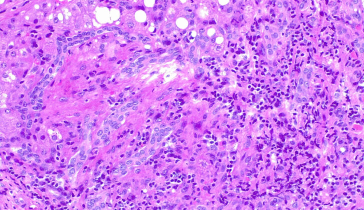 Liver Biopsy Hematoxylin and Eosin Stain. Liver Biopsy hematoxylin and eosin stain showing chronic inflammation in a distorted portal space, a feature of chronic hepatitis.  