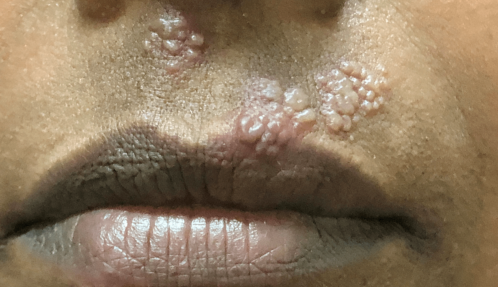 Herpes Simplex mouth