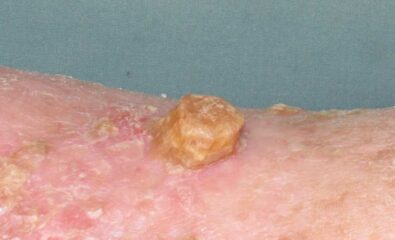 Cutaneous Horn