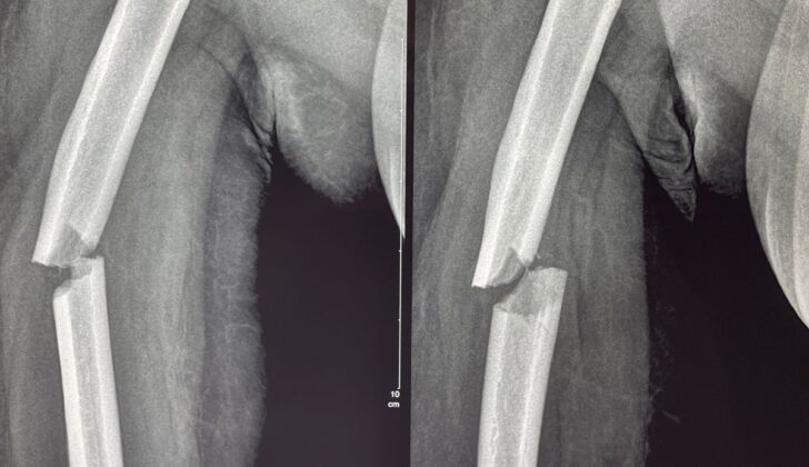 Oblique Humeral Shaft Fracture. This radiograph shows an oblique, displaced middle-third humeral fracture.